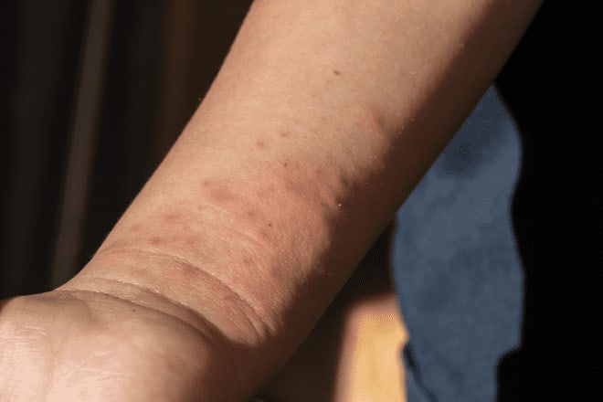 plusieurs piqures de punaises de lit